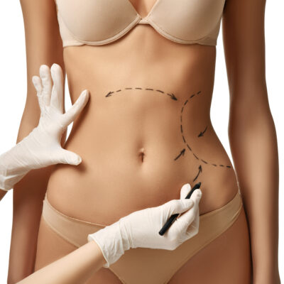 Weighing The Options For Liposuction