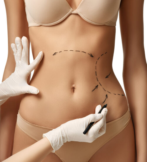 Weighing The Options For Liposuction